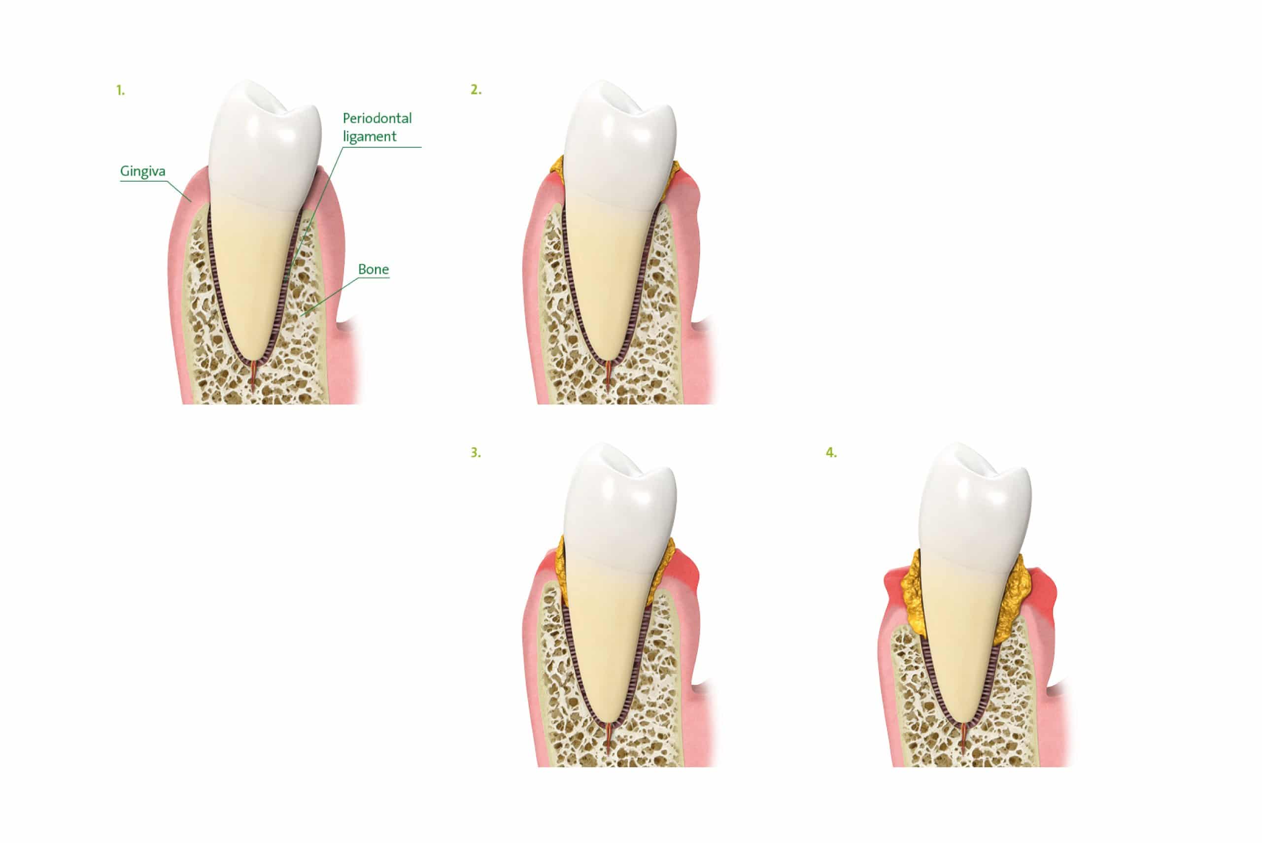 Periodontal disease Guildford Dentist