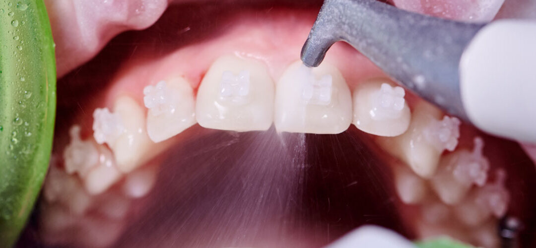 How Mouth Hygiene Treatments Enhance Cosmetic Dentistry Results