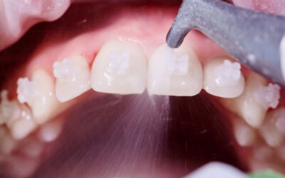 How Mouth Hygiene Treatments Enhance Cosmetic Dentistry Results