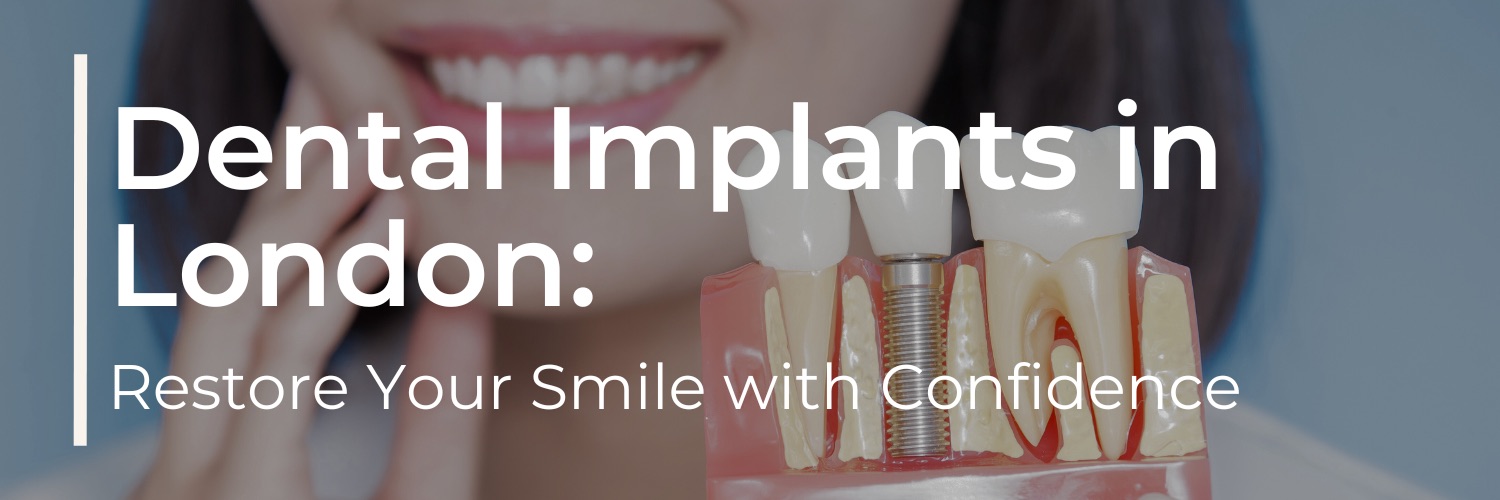 Dental Implants in London: Restore Your Smile with Confidence at Levitas Dental Clinic in Mayfair