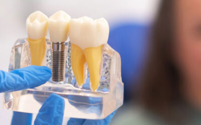 Dental Implants in London: Restore Your Smile with Confidence at Levitas Dental Clinic in Mayfair